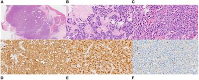 RET gene fusion and emergent Selpercatinib resistance in a calcitonin-rich neuroendocrine carcinoma: a case report